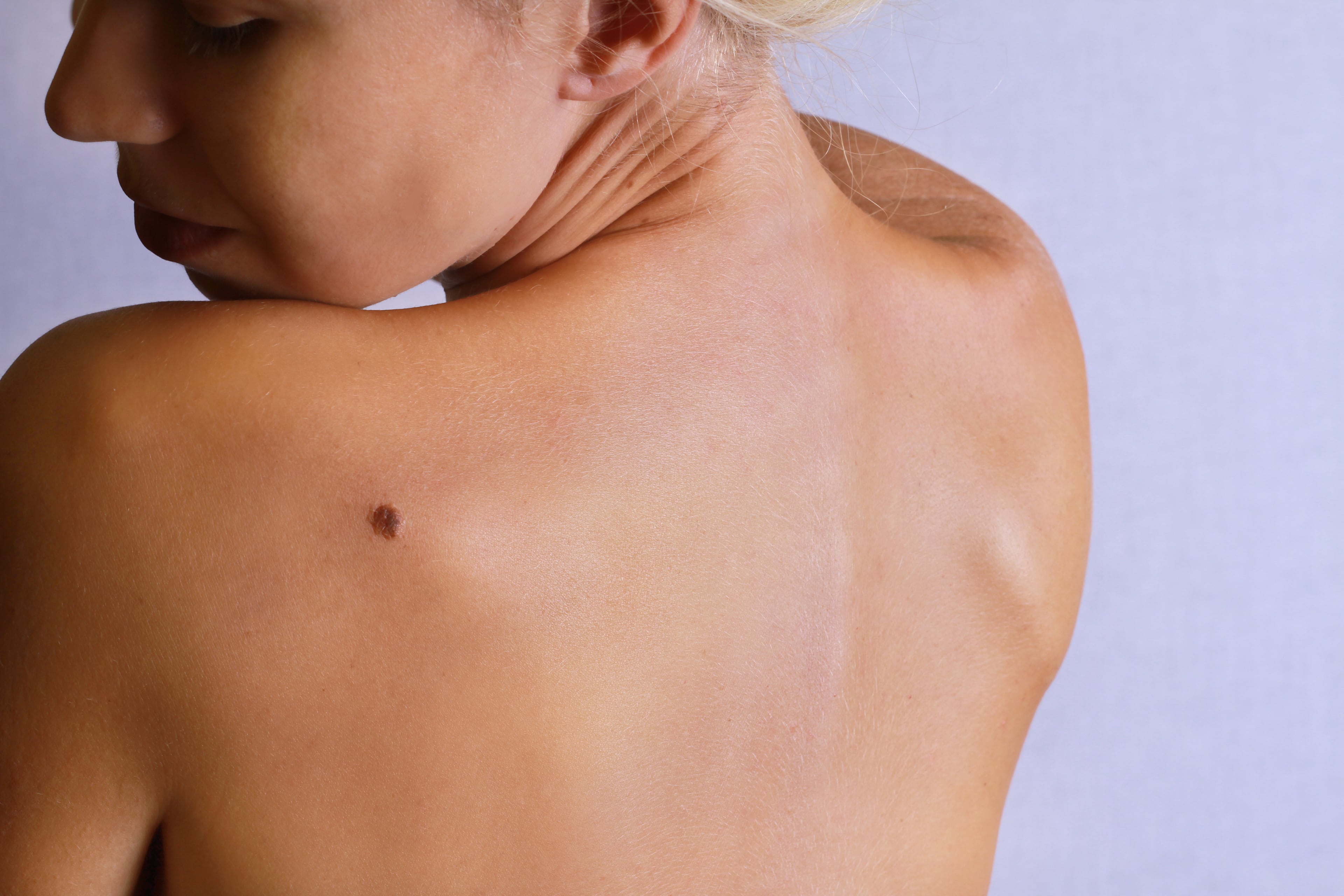папилломы на груди у женщин фото 116